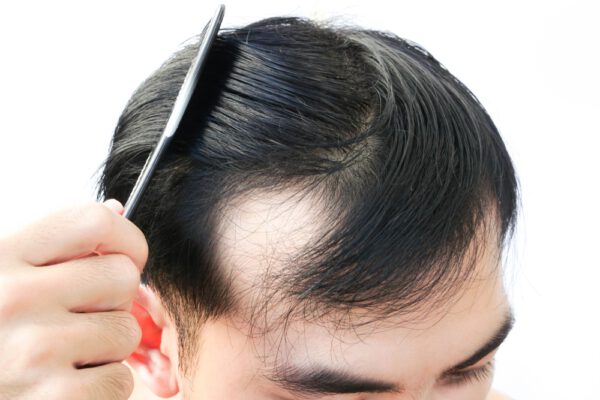 Rụng tóc từng mảng Nguyên nhân dấu hiệu chẩn đoán và cách trị