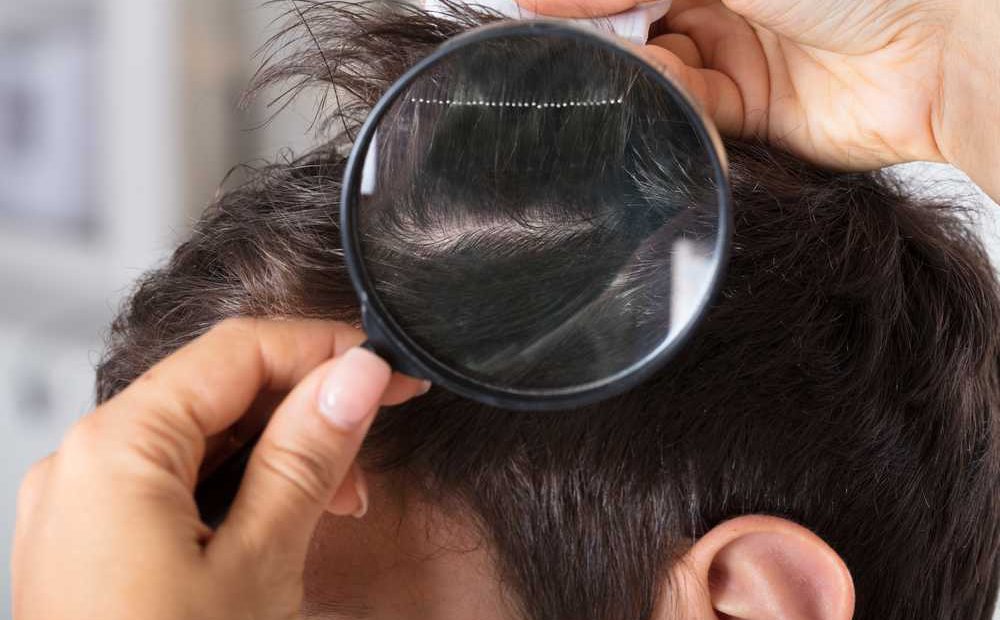 Đánh bay tình trạng tóc dầu nam giới với các nguyên liệu tự nhiên