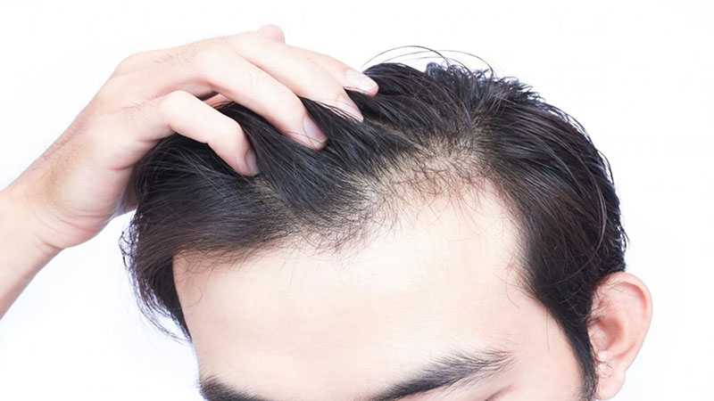 Cơ chế bệnh sinh rụng tóc và giải pháp điều trị, kích thích mọc tóc | VIGO