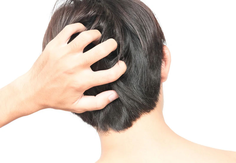 Nấm da đầu gây rụng tóc cho nam giới