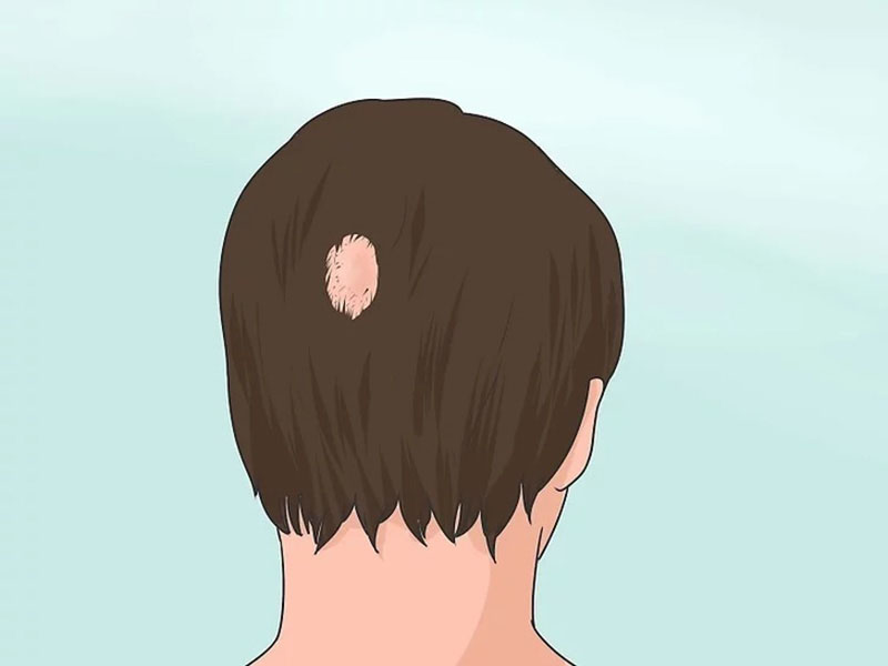 Nấm da đầu gây rụng tóc ở nam tuổi dậy thì