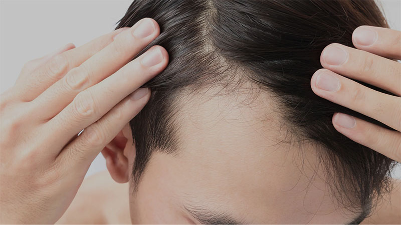 Các biện pháp tránh thai có thể gây rụng tóc?
