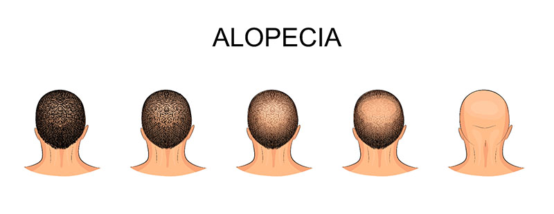 Rụng tóc kiểu Alopecia