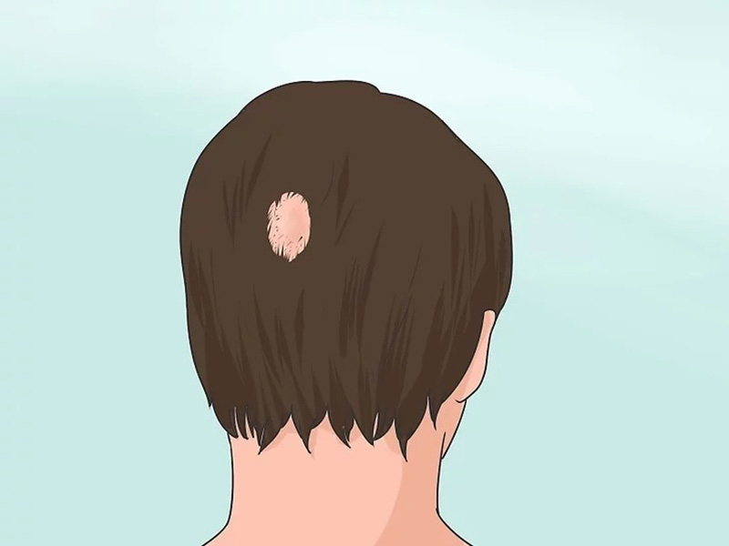 Nguyên nhân rụng tóc ở nam do bệnh vảy nến