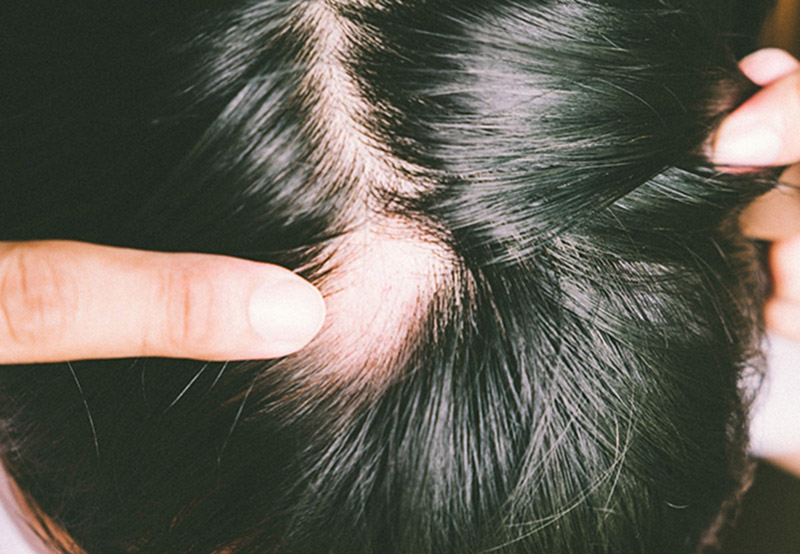 Nguyên nhân rụng tóc ở nam do bệnh tuyến giáp