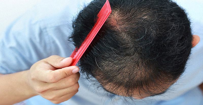 Nguyên nhân rụng tóc ở nam do mất cân bằng hormone giới tính