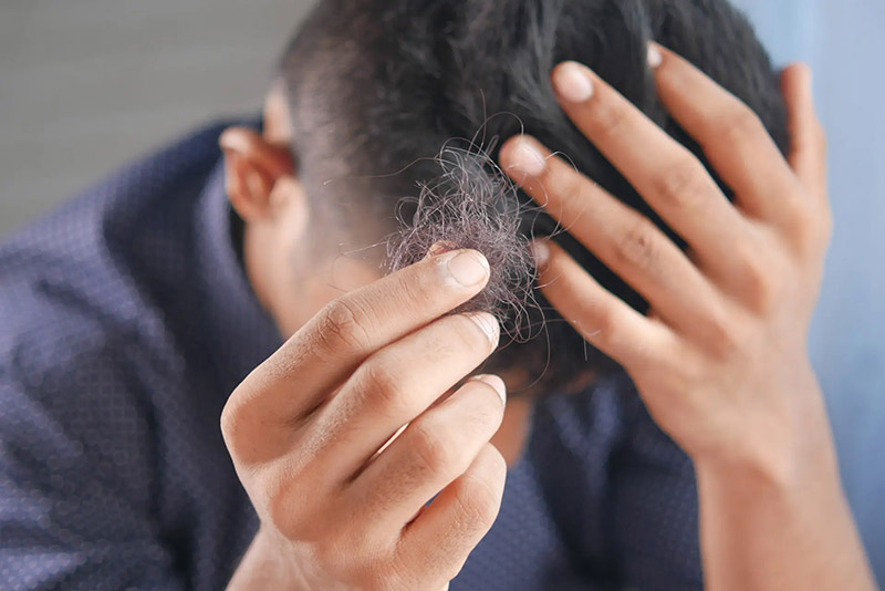 Nguyên nhân rụng tóc ở nam do căng thẳng