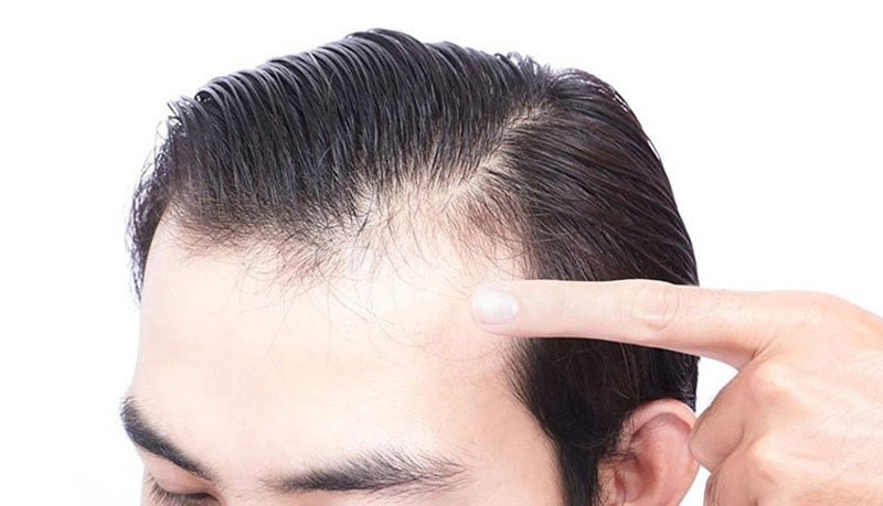 Nguyên nhân rụng tóc ở nam do di truyền