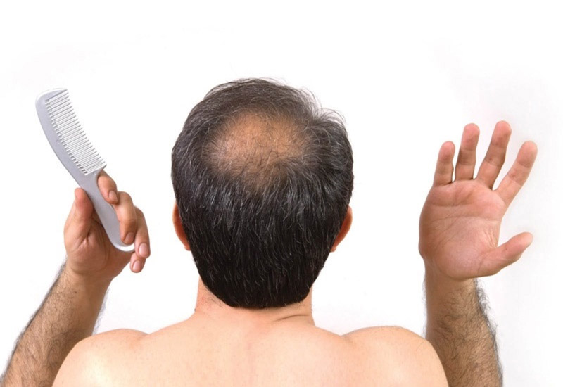 Gen di truyền khiến tóc rụng