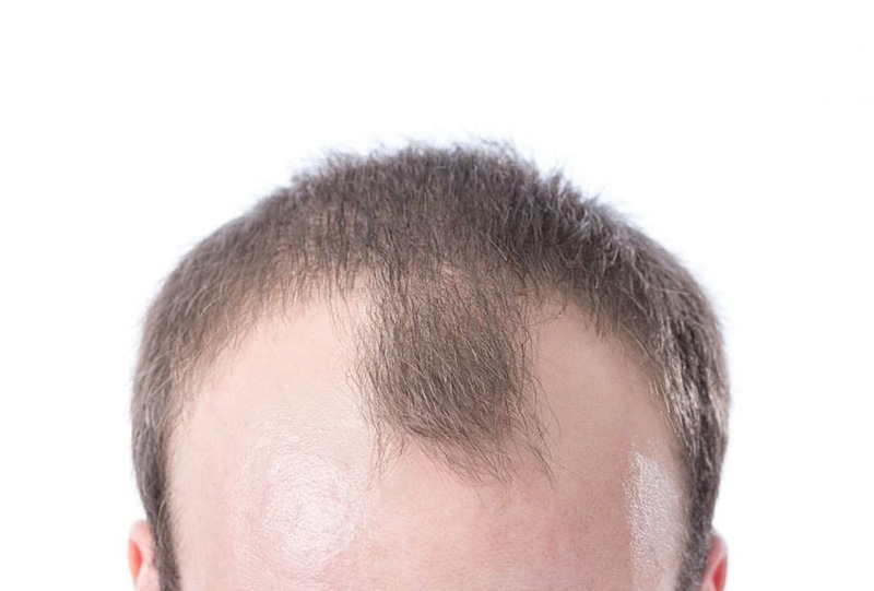 Rụng tóc ở giai đoạn 4