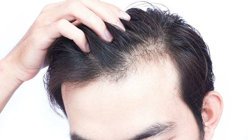 Rụng tóc ở nam có thể mọc lại hoặc không
