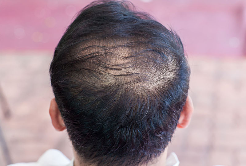 Rụng tóc ở nam do yếu tố sinh lý